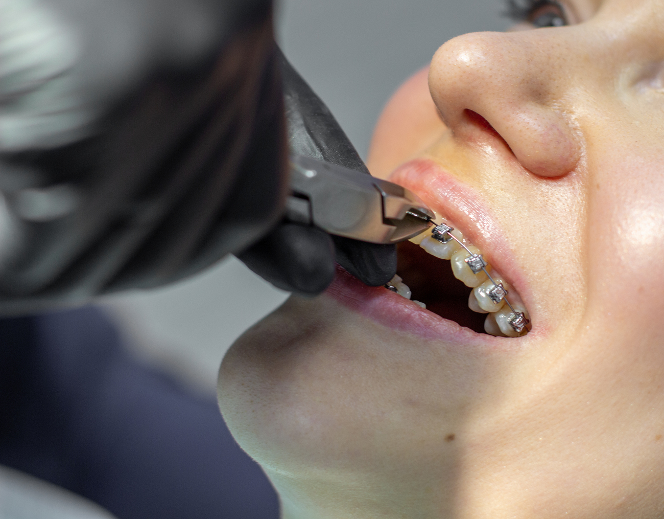 Comparativa con Brackets Tradicionales