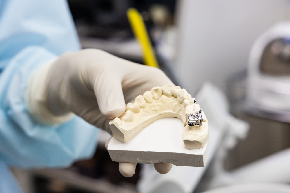 Qué factores reducen la vida útil de una prótesis dental