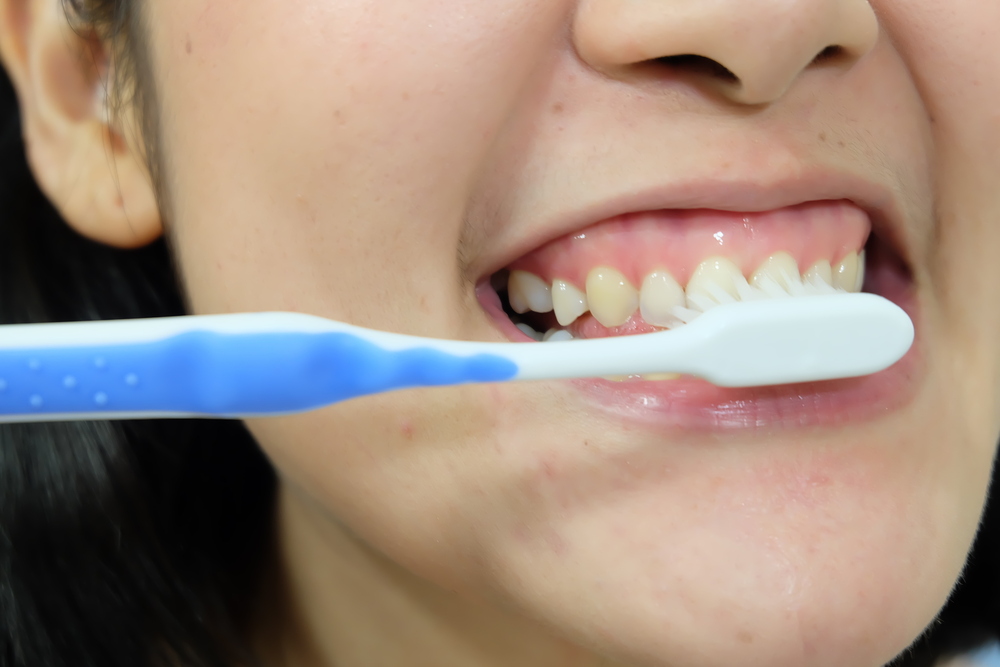 Prevención del Sangrado de Encías