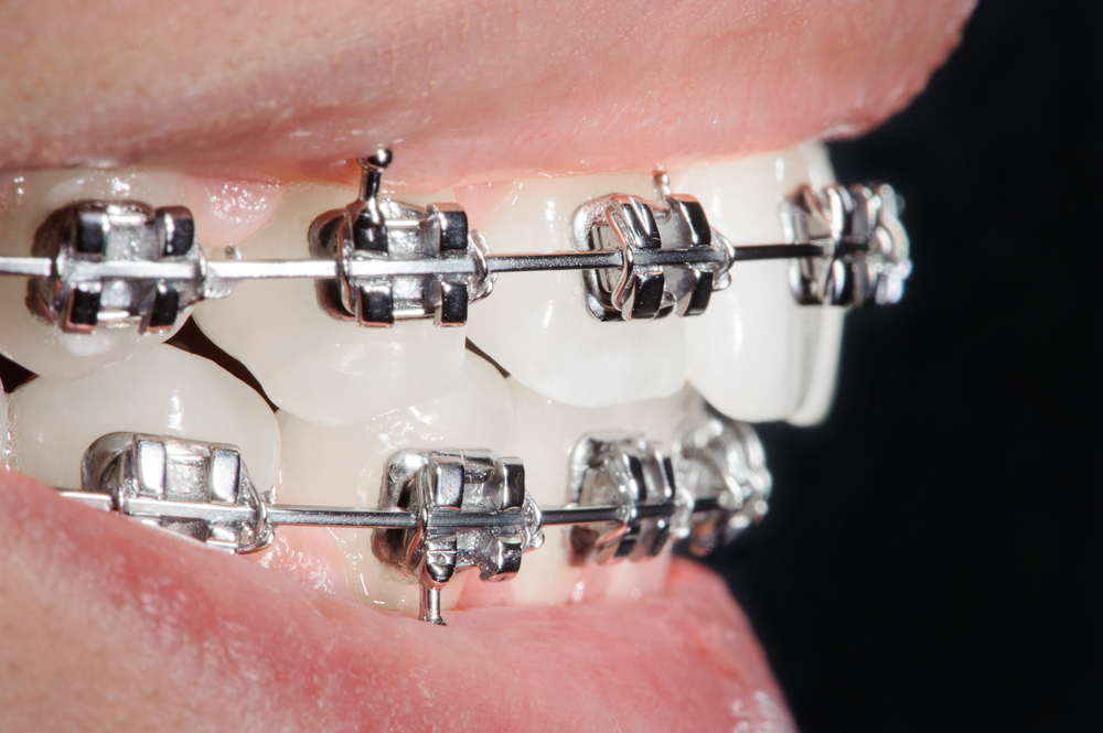 Preguntas Frecuentes sobre Cepillado con Brackets