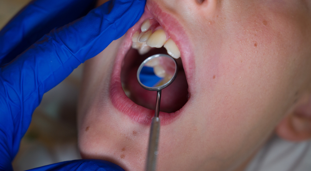 Qué Causa un Agujero en el Diente