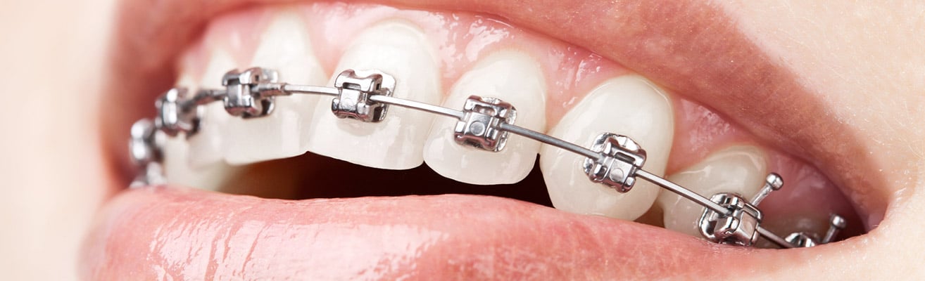 Brackets autoligables