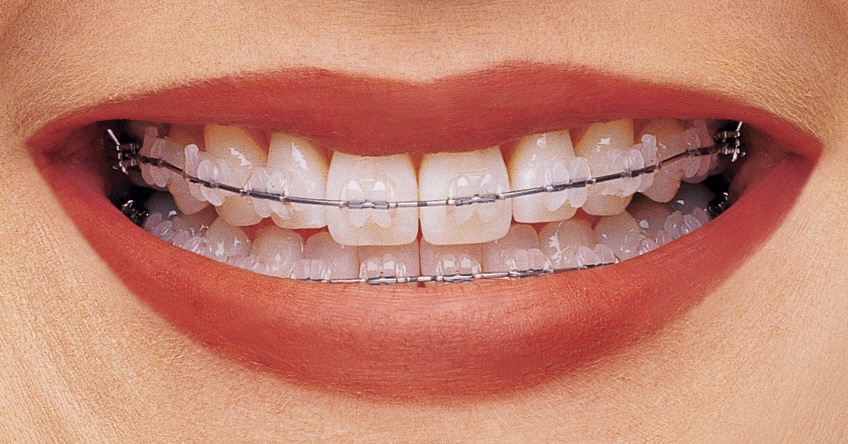 Brackets estéticos