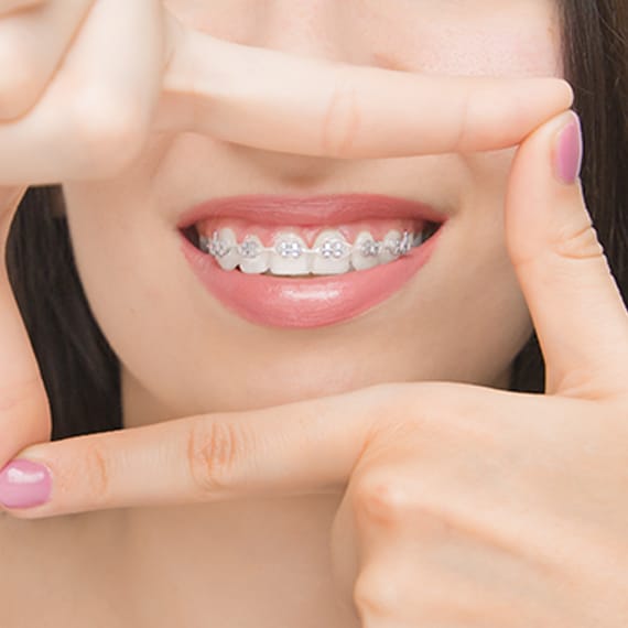 Brackets estéticos