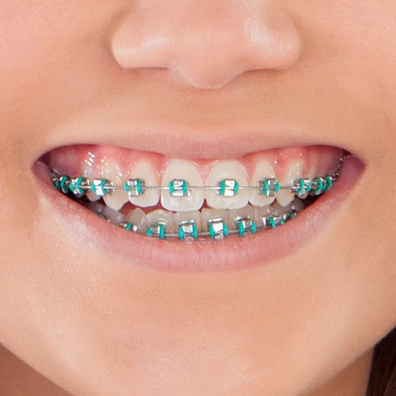 Brackets metálicos