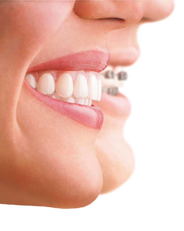 Invisalign en Panamá