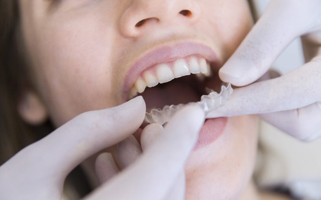 3 Momentos clave en tu tratamiento con Invisalign