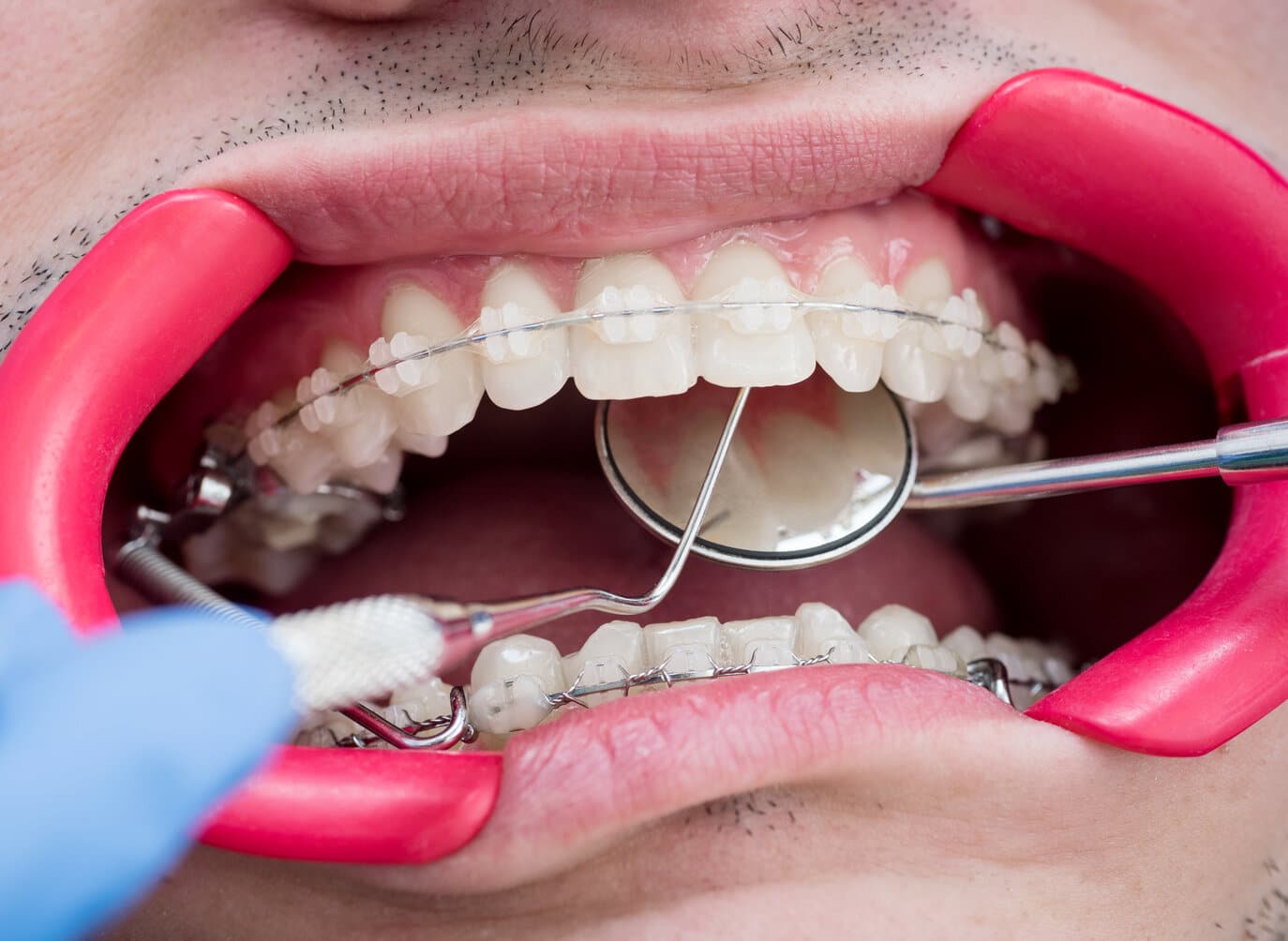Brackets de Zafiro