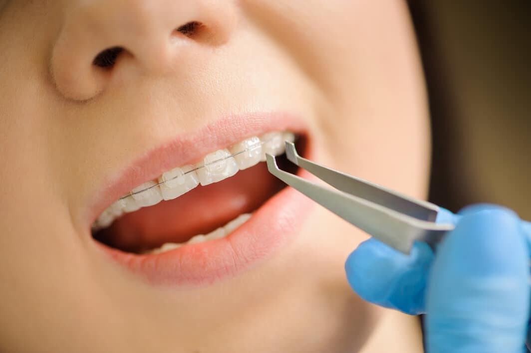 Brackets de Cerámica