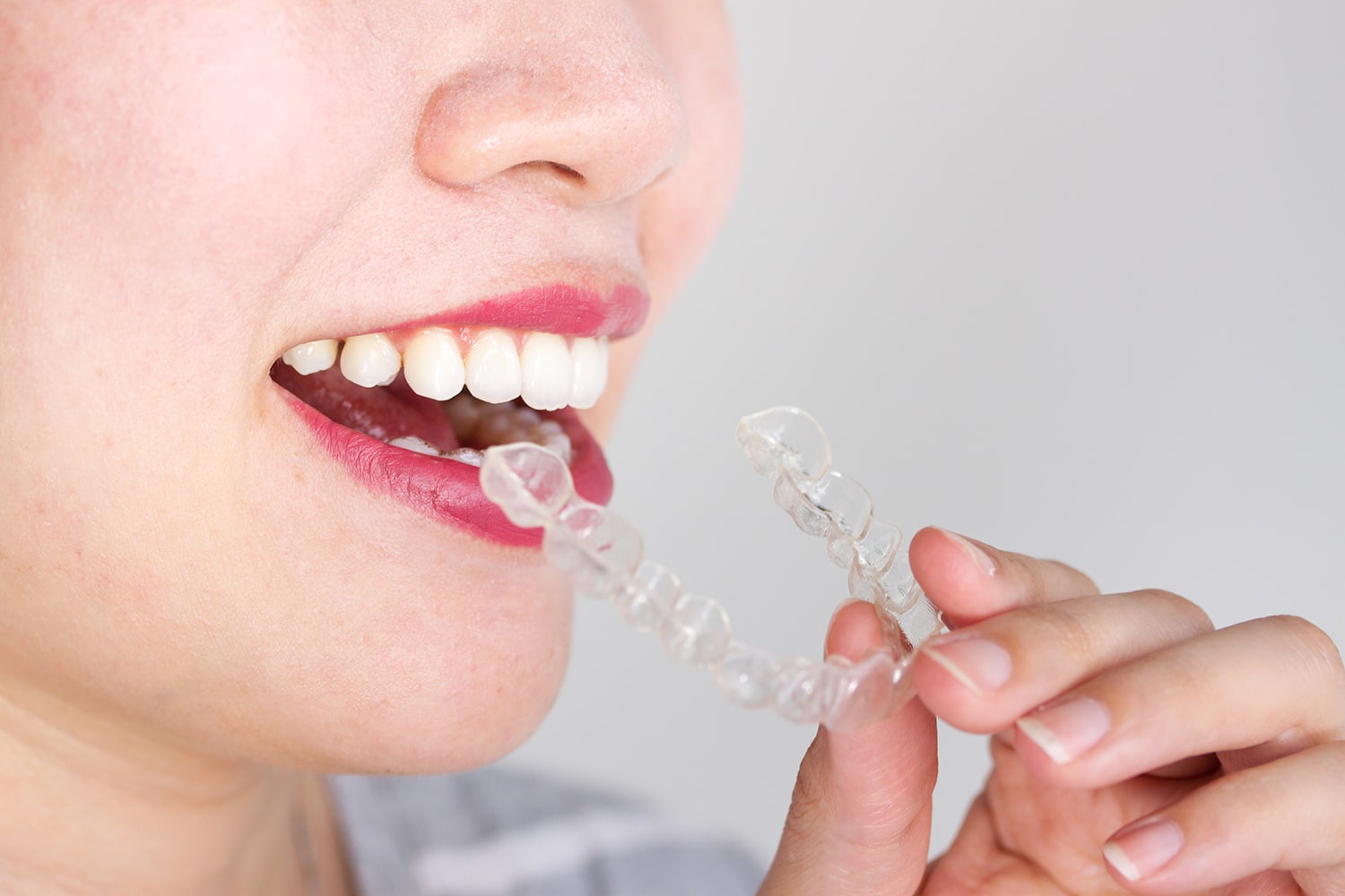 Invisalign es el recomendado