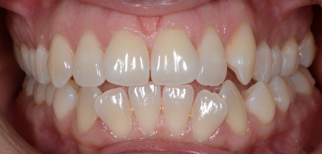 Apiamiento-Dental Apiñamiento