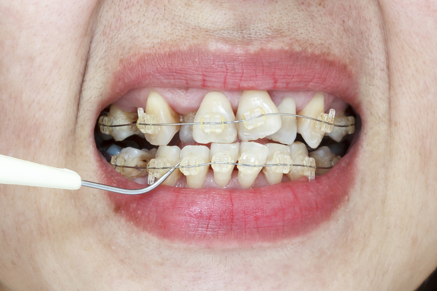 Clasificación del Apiñamiento Dental