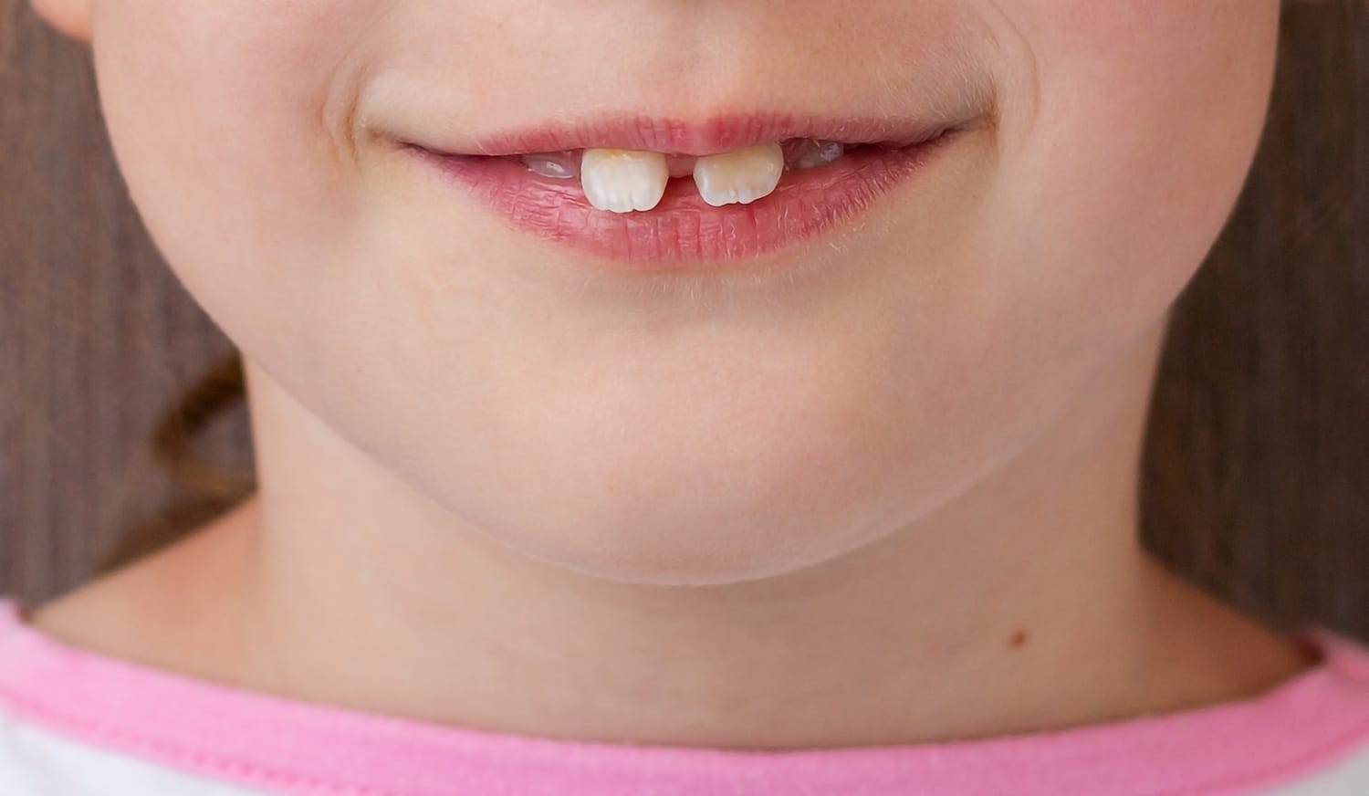 Diastema En Niños Diastema en Niños
