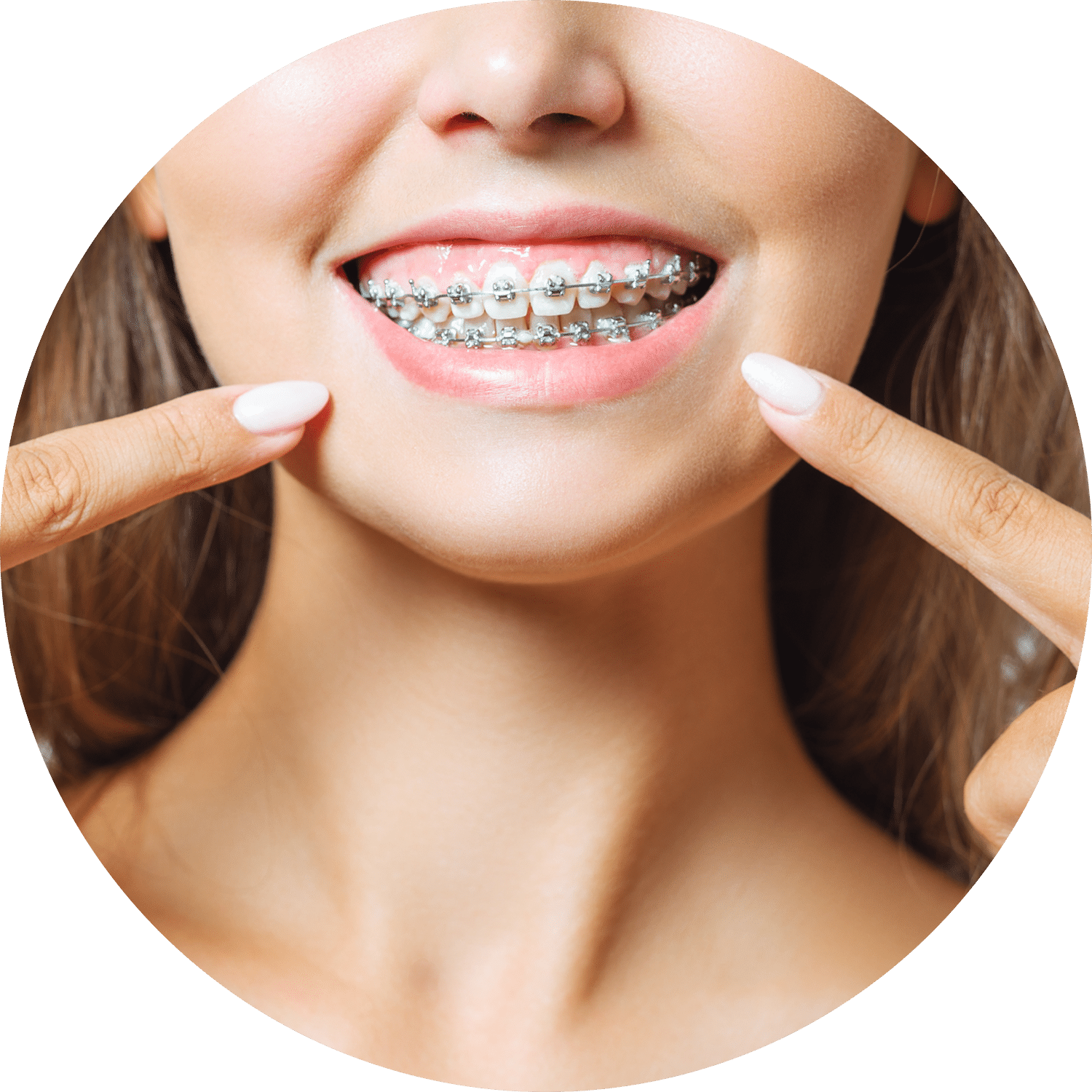 brackets autoligables