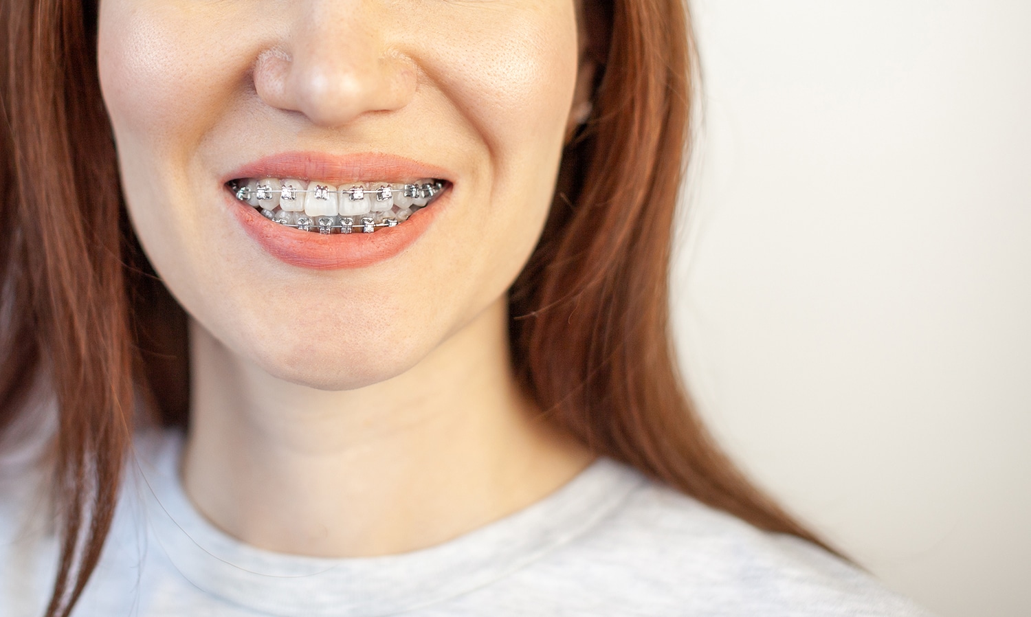 Dudas Sobre Invisalign® En Panamá Dudas sobre Invisalign® en Panamá