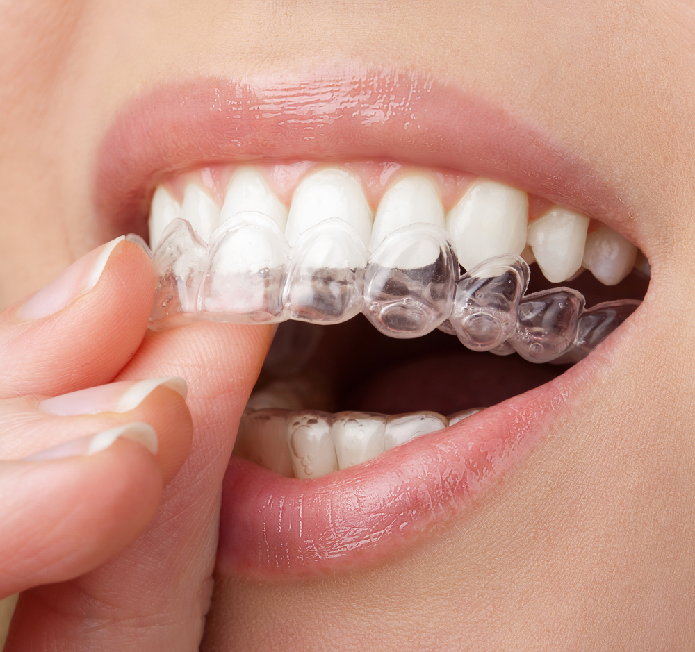 Cuánto Dura el Tratamiento Completo Invisalign®