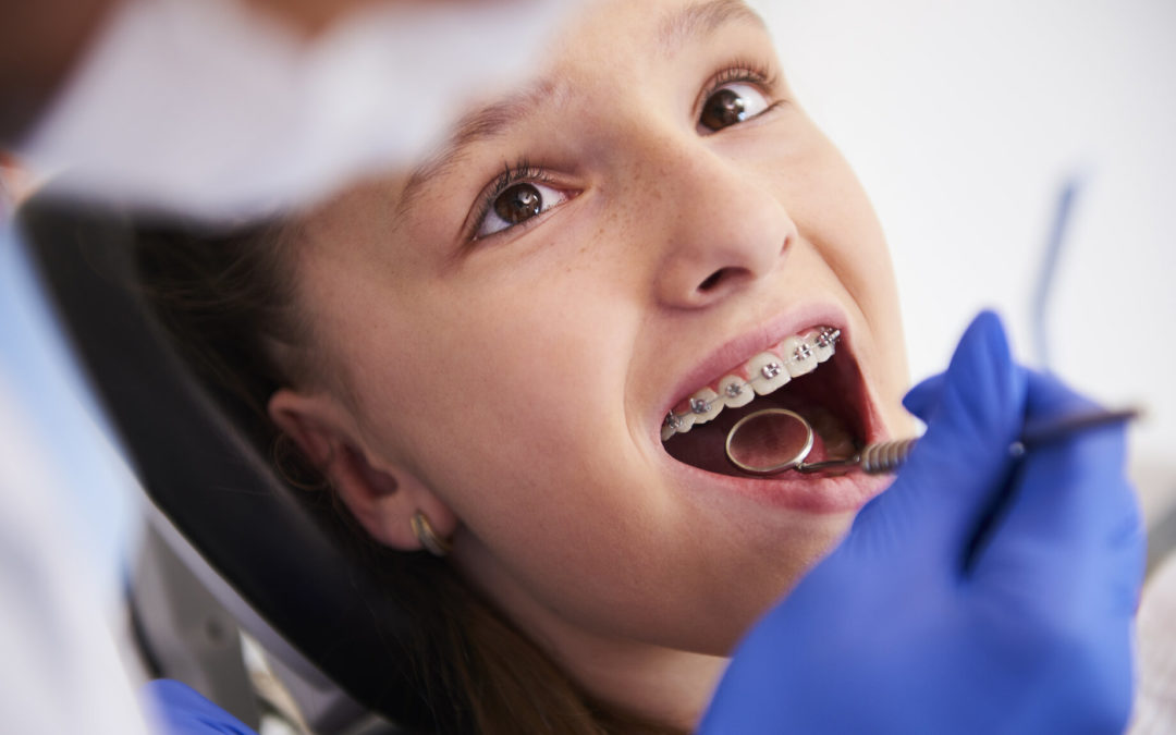 ¿Cómo se hace y qué debo esperar de una limpieza dental?
