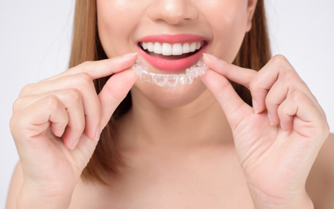 ¿Por qué se cambian los alineadores Invisalign cada 15 días?