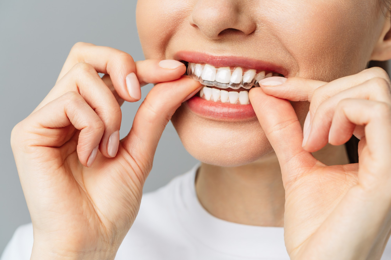 Reemplazo De Alineadores Invisalign® Reemplazo de Alineadores Invisalign®