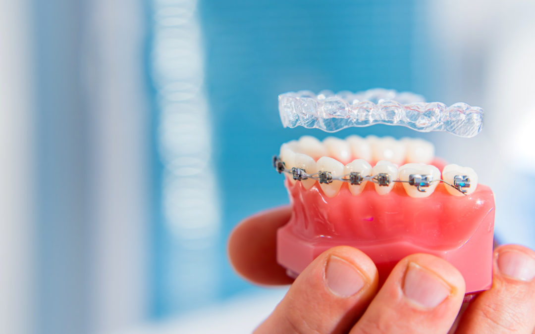 ¿Brackets o Invisalign?