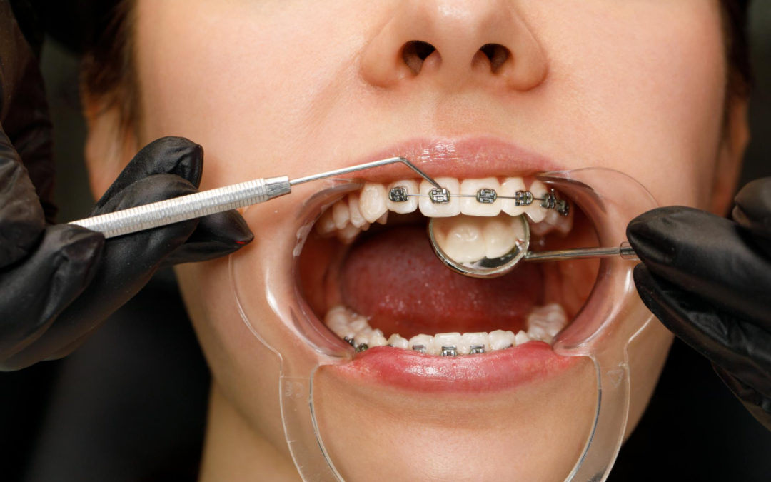 ¿Cuándo debo considerar un retratamiento de ortodoncia?