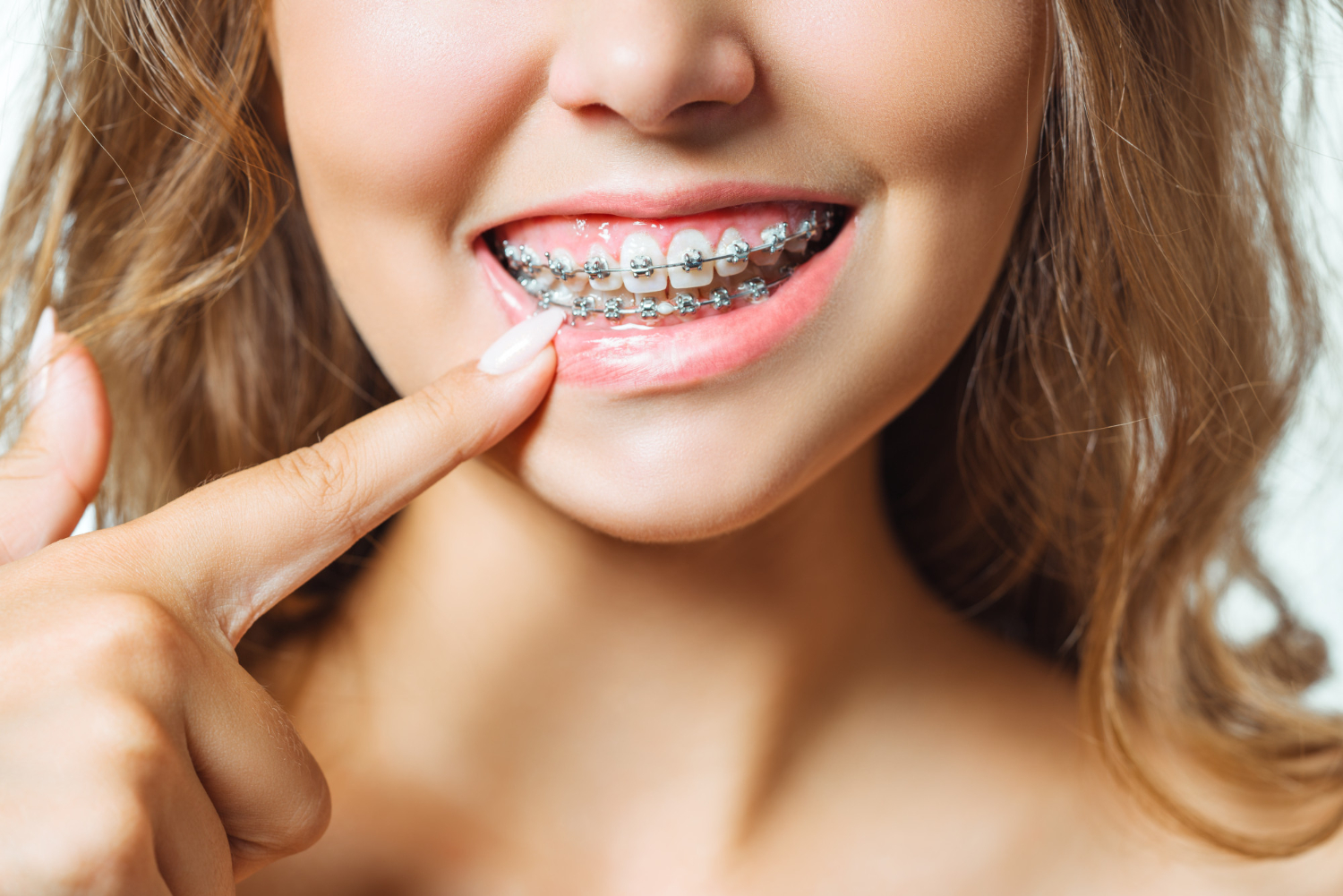 En qué consiste el tratamiento con frenillos dentales