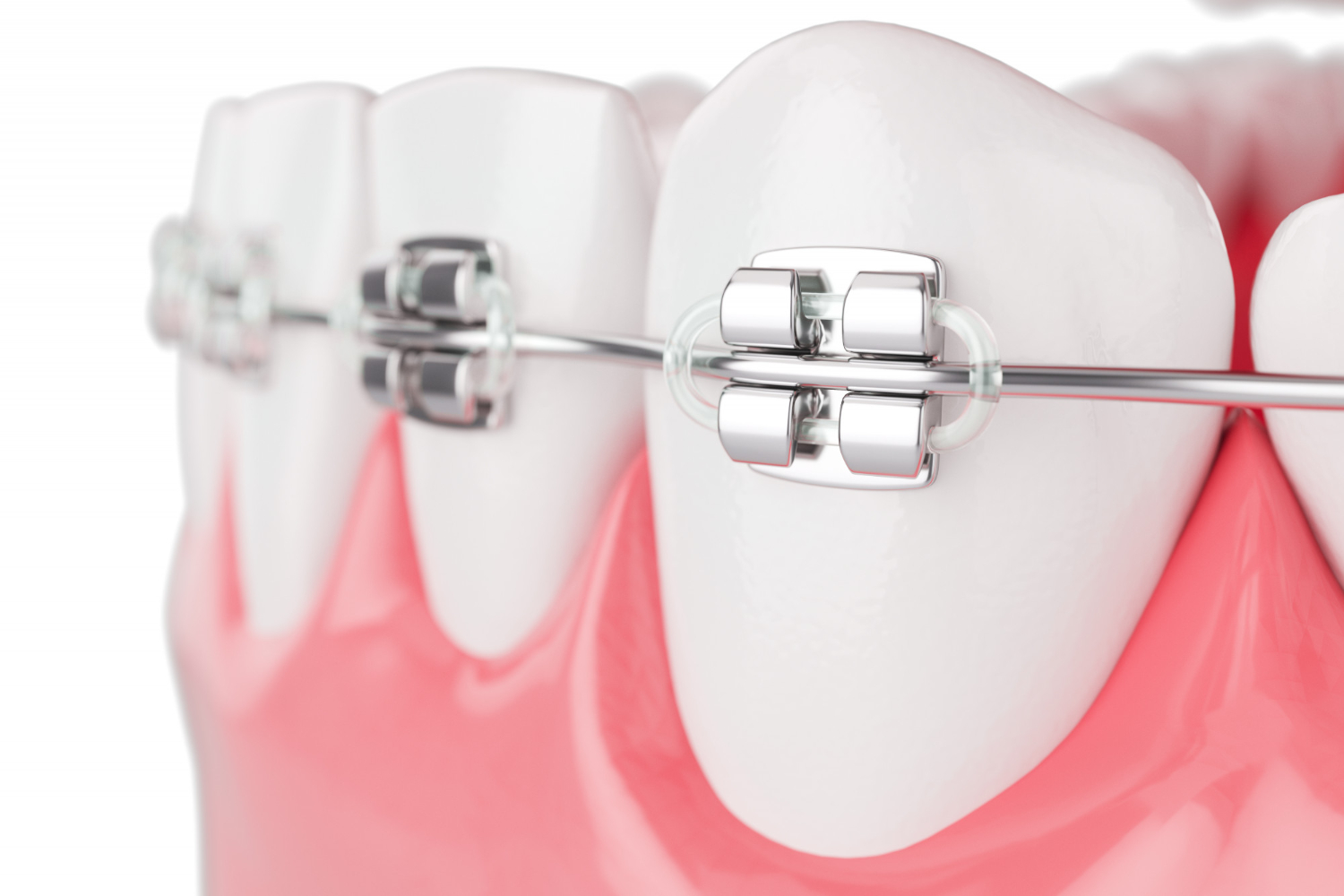 Qué es y para qué sirve frenillos dentales