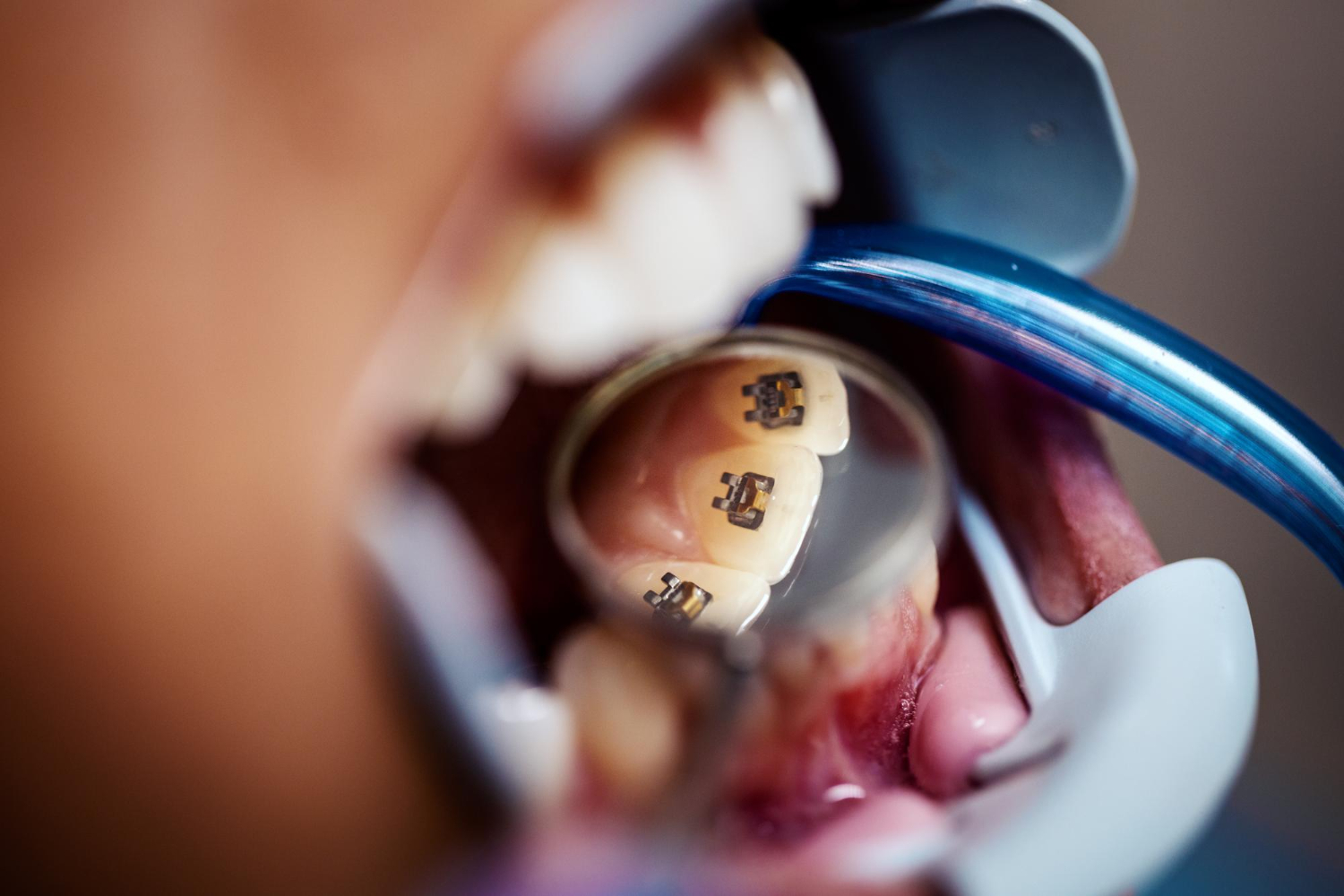 Cómo Funcionan Los Brackets U Ortodoncia Lingual Cómo funcionan los brackets u ortodoncia lingual