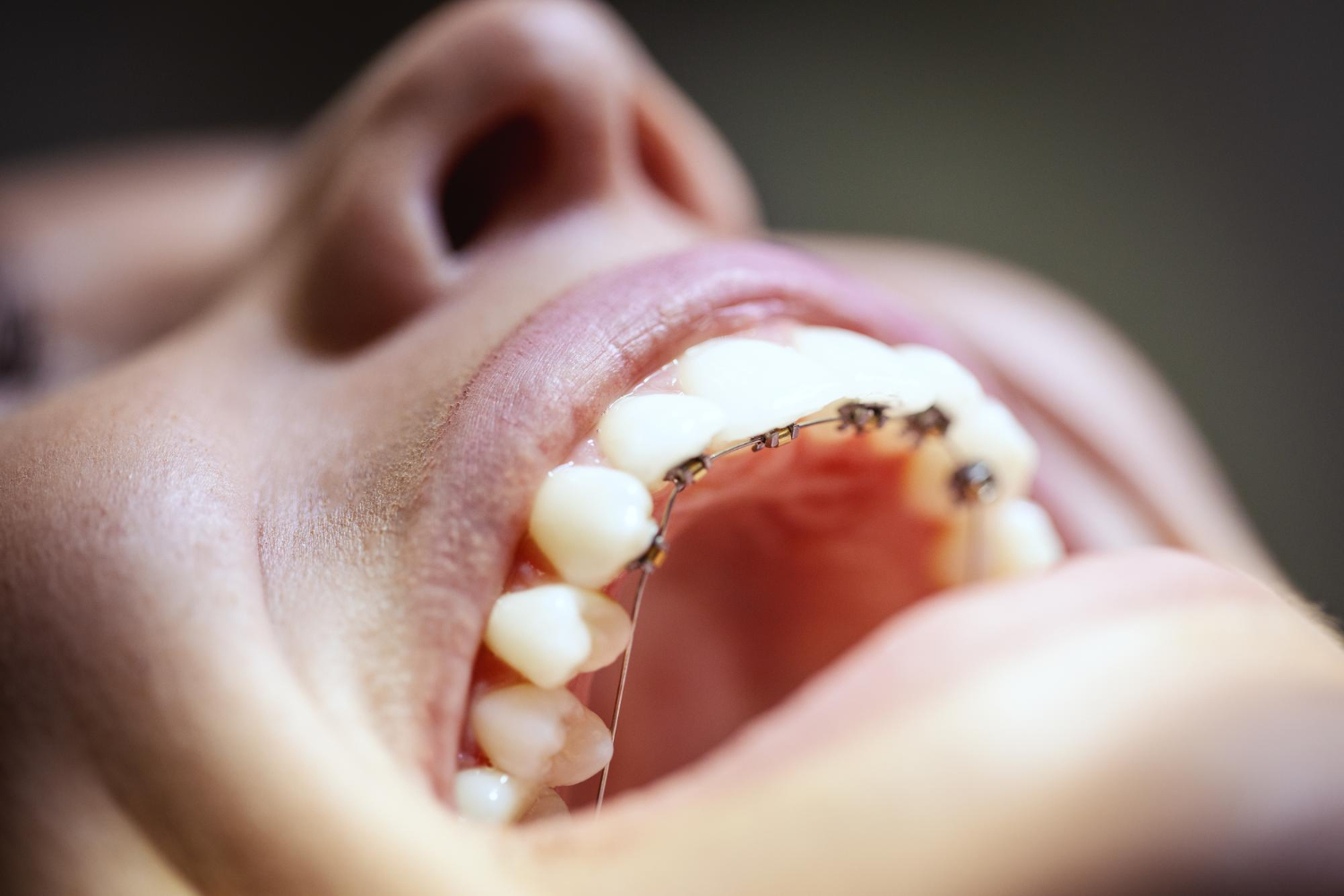 Qué es y cómo se distingue la ortodoncia lingual