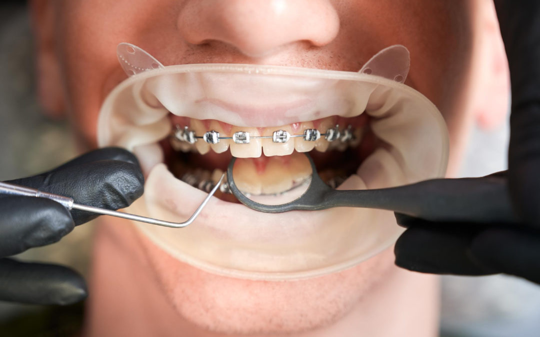 ¿Cuáles son los tipos de ortodoncia más usados?