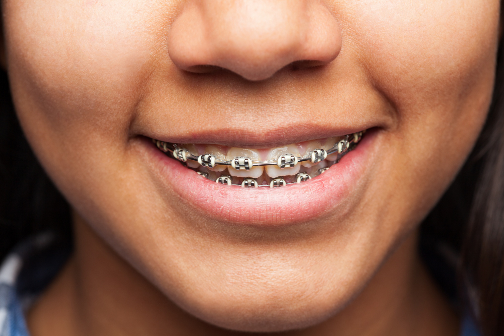 Cuántos tipos de ortodoncia existen en la actualidad