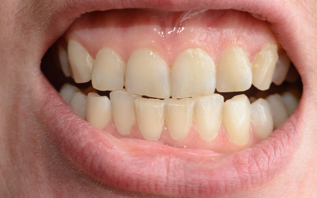Conoce las causas y consecuencias de los dientes torcidos