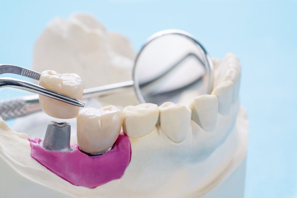 Cuáles son mejores, las coronas de titanio o zirconio