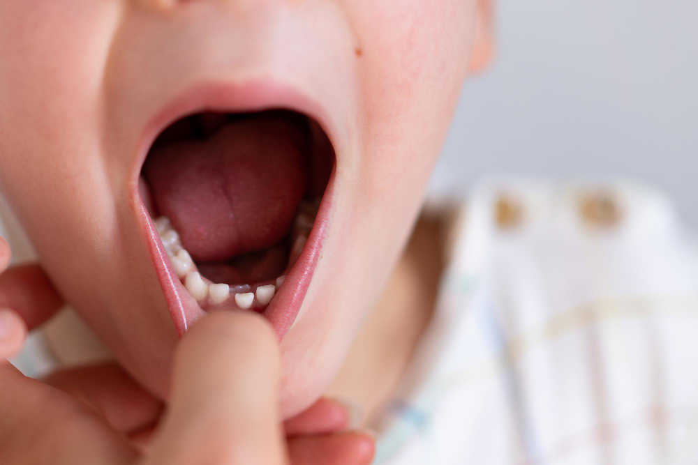 Cuándo se caen los dientes de leche