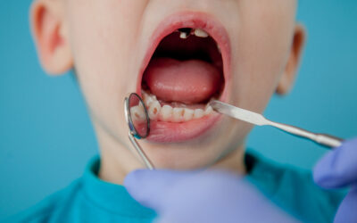 Cómo eliminar las manchas blancas en tus dientes