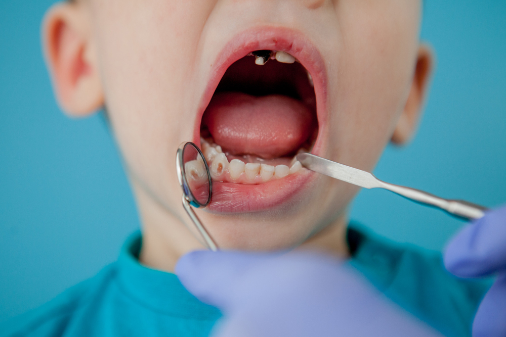 Cómo eliminar las manchas blancas en tus dientes