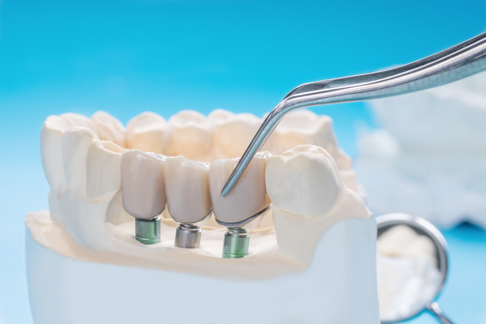 Prótesis Dental Prótesis dental