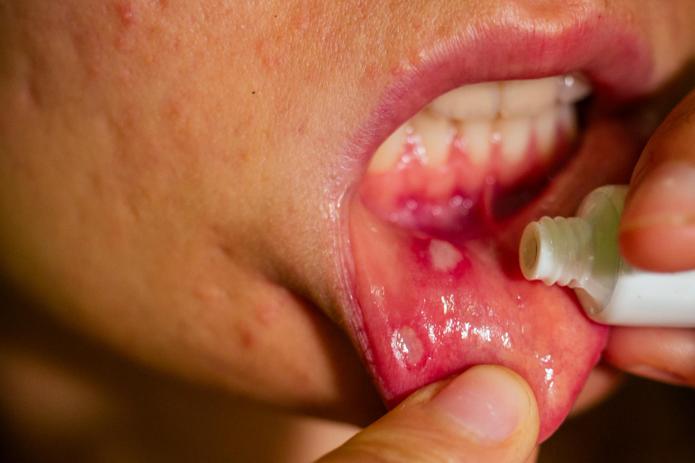 Causas de las úlceras dentales