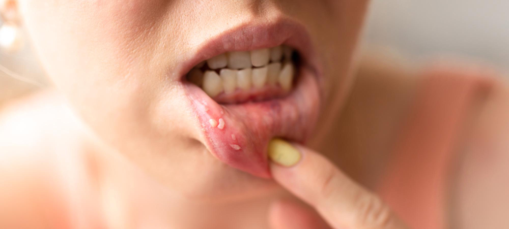 Síntomas de las úlceras dentales