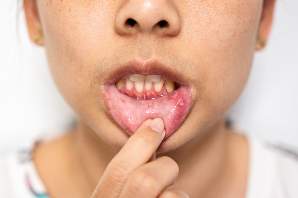 Tratamiento De Úlceras Dentales Tratamiento de úlceras dentales