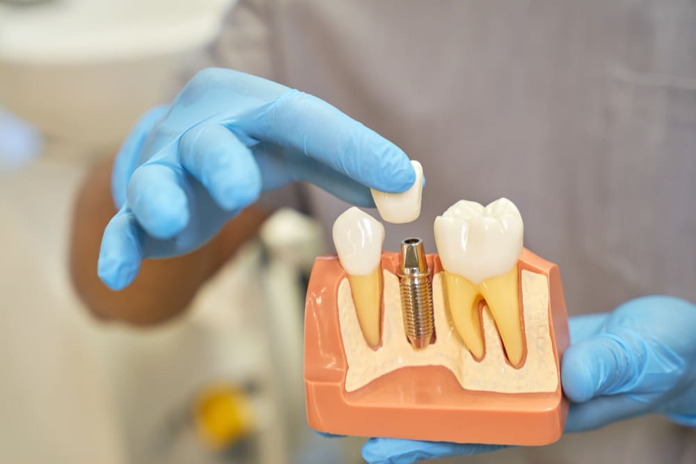 Cómo es el tratamiento con prótesis dentales en Panamá