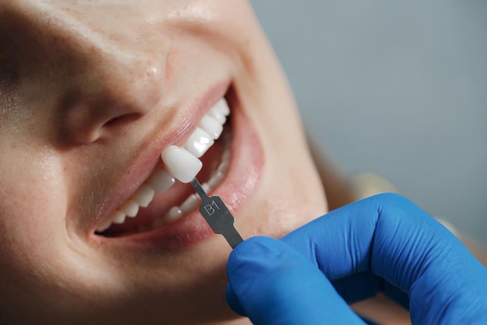 Precio Del Tratamiento De Carillas Dentales De Zirconio Precio del tratamiento de carillas dentales de zirconio