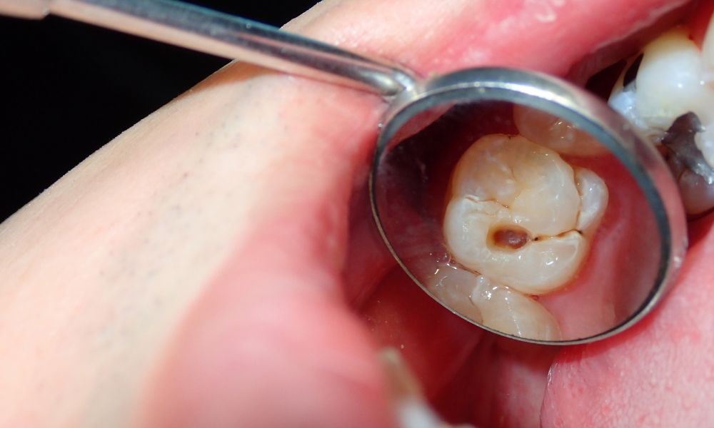 Causas y factores de riesgo de la erosión dental