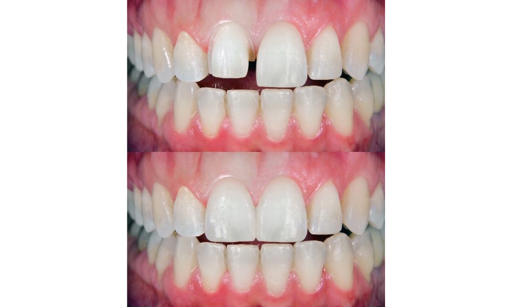 Before and after dental veneers