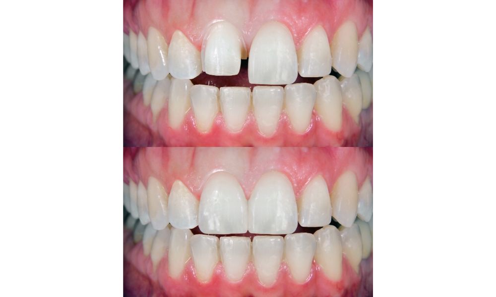 Antes y después carillas dentales