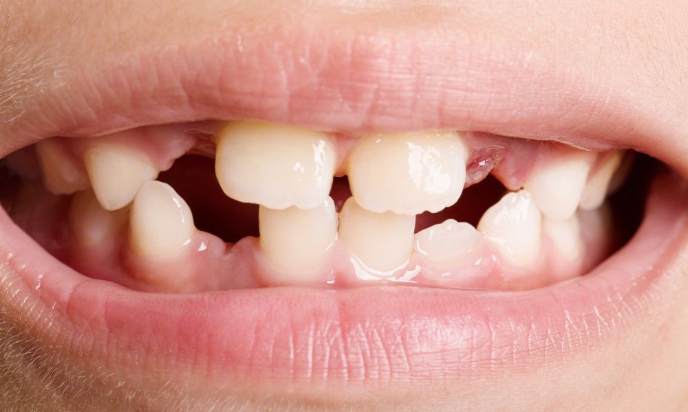 Causas del desgaste de los dientes de leche