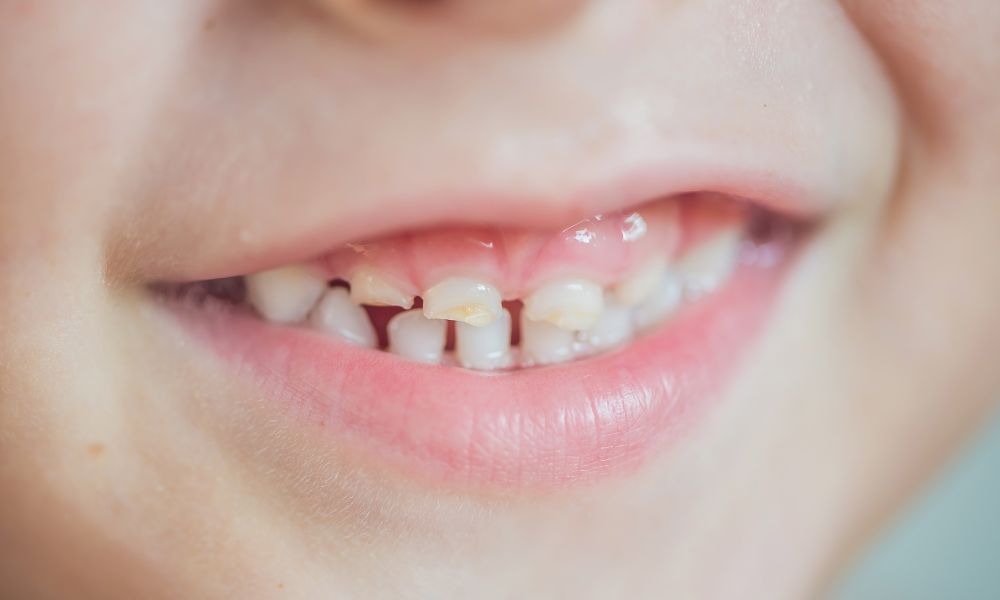 Signos de dientes de leche desgastados