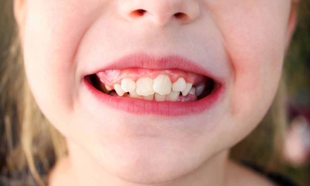 Causas Comunes del Apiñamiento Dental