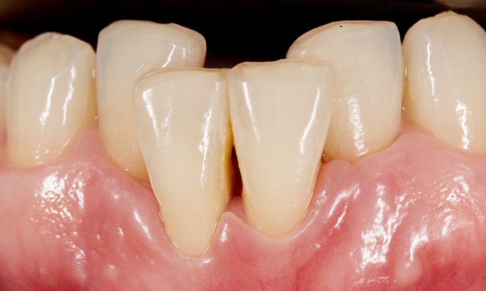 Problemas Asociados con los Dientes Apiñados