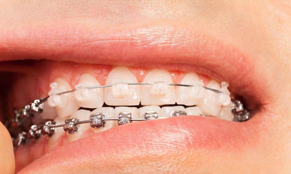 Ingestión Accidental de Cera Dental